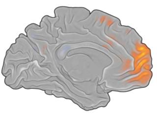 Back-projected left hemisphere surface with activation map